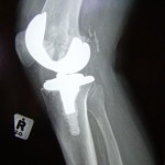 knee-replacement---side-view-1183622-m